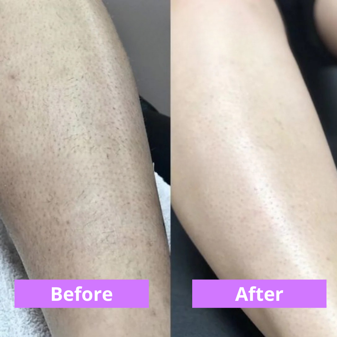 Cyperus Rotundus Natural Hair Reduction Oil™