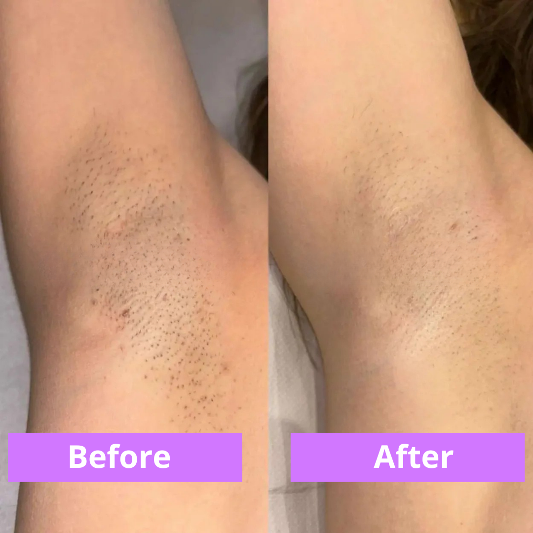 Cyperus Rotundus Natural Hair Reduction Oil™